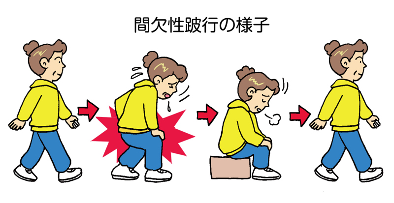 間欠性跛行の様子